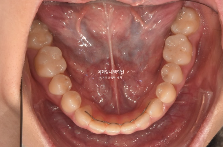 앞니 단기 부분교정 재교정 개방교합 교정 후기 관련 이미지 5