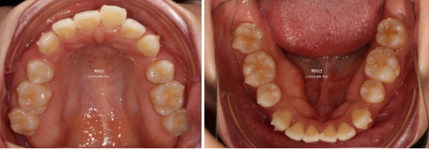 30대 돌출입 덧니 교정 인비절라인 발치교정 후기 관련 이미지 7