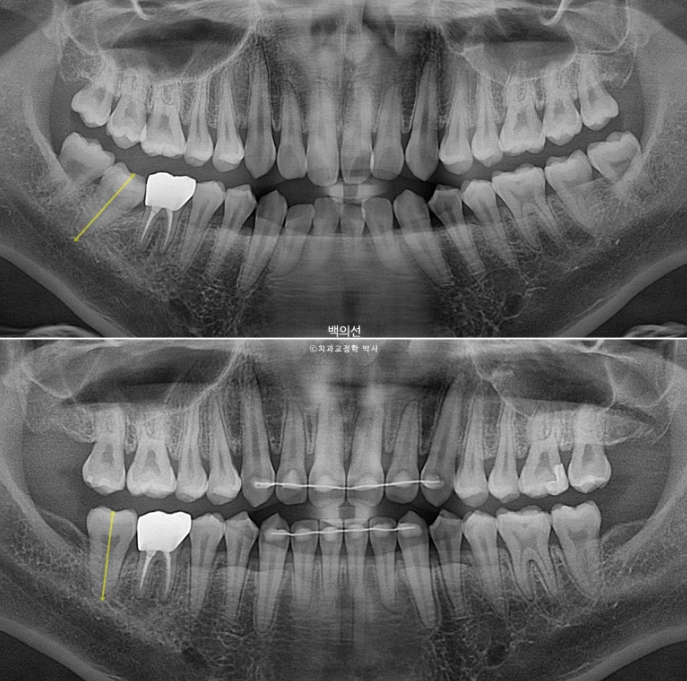 가위교합 나비치아 미니스크류 덧니 교정 인비절라인 라이트 관련 이미지 24