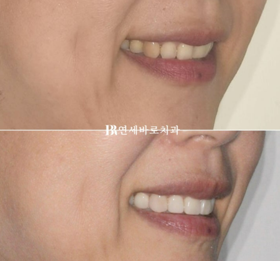 역류성 식도염으로 갈린 치아&hellip; 무삭제 라미네이트로 자연스럽게 회복 관련 이미지 5