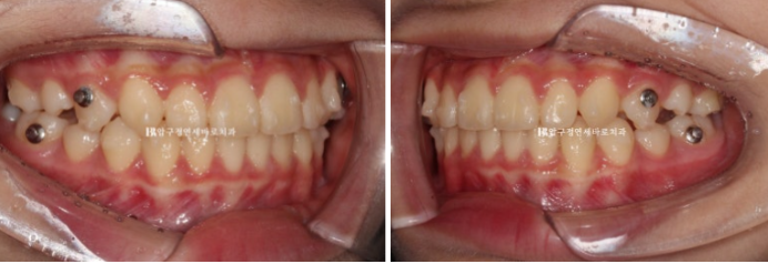 어린이교정 투명교정 인비절라인 퍼스트 후기 관련 이미지 9