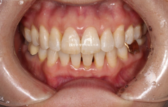 50대 중년교정 인비절라인 라이트 나비치아 교정 앞니 교정 후기 관련 이미지 9