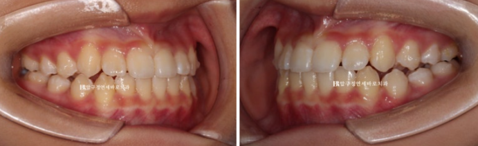 Simultaneous Arch Expansion and Teeth Alignment for Elementary School Children with Invisalign｜Invisalign First image 9