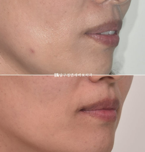 Orthodontic Retreatment in Your 40s | Improvement of Chin Retrusion and Lip Incompetence with Intrusion Orthodontics, Non-Extraction Orthodontic Treatment in Your 40s image 8