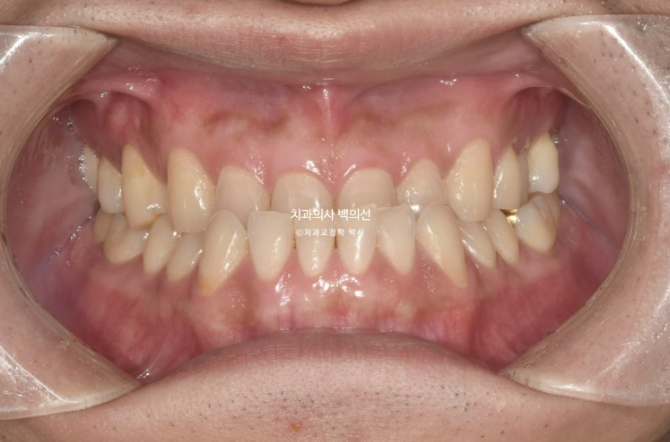 30대 주걱턱 비수술 비발치 교정 후기 관련 이미지 1