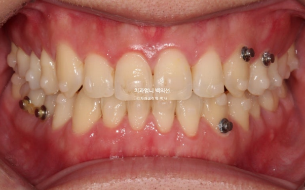 MSE Palatal Expansion Invisalign Underbite Correction, Non-Surgical image 12