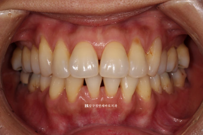 How Can Black Triangles Be Removed? Is Re-treatment Orthodontics an Option? image 2
