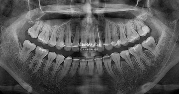 잇몸미소 인비절라인 거미스마일 토끼이빨 교정 무삭제 라미네이트 반대교합 치료 후기 관련 이미지 23