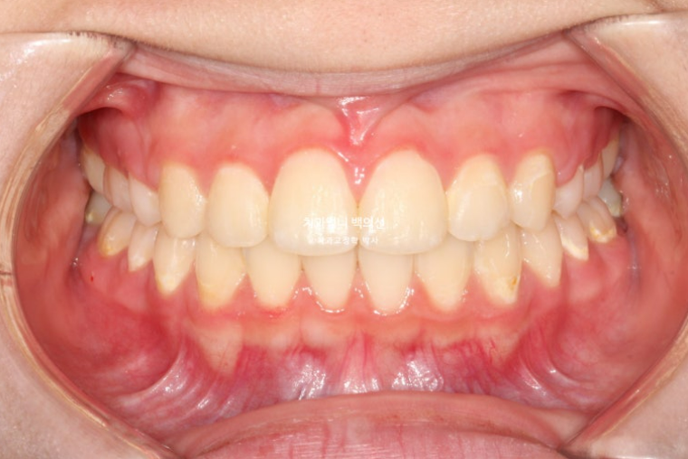 입이 안 다물어짐 입술부전증 호두턱 교정? 관련 이미지 10