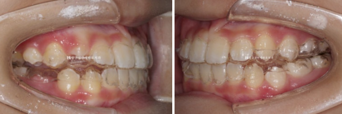 Simultaneous Arch Expansion and Teeth Alignment for Elementary School Children with Invisalign｜Invisalign First image 6