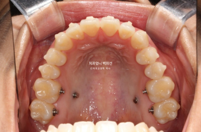 인비절라인 개방교합 교정 어금니 함입 교정 비베라? 관련 이미지 7