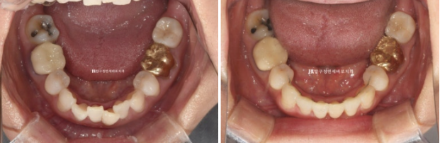 50대 중년교정 인비절라인 라이트 나비치아 교정 앞니 교정 후기 관련 이미지 12