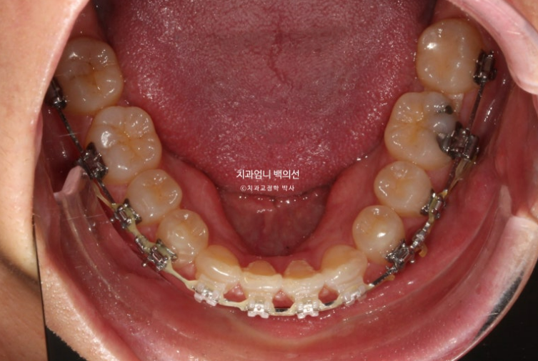 30대 교정 돌출입 교정 덧니 발치교정 치료기간 1년 8개월 관련 이미지 8