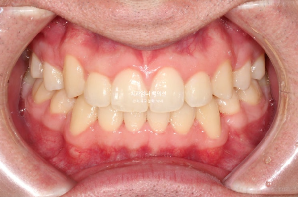 투명교정 인비절라인 덧니 교정 치료기간 알아보기 관련 이미지 8