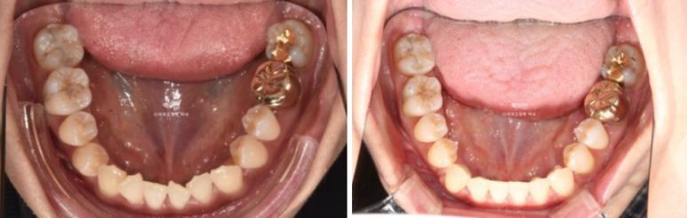 30대 비수술 비발치 주걱턱 부정교합 인비절라인 교정 관련 이미지 11