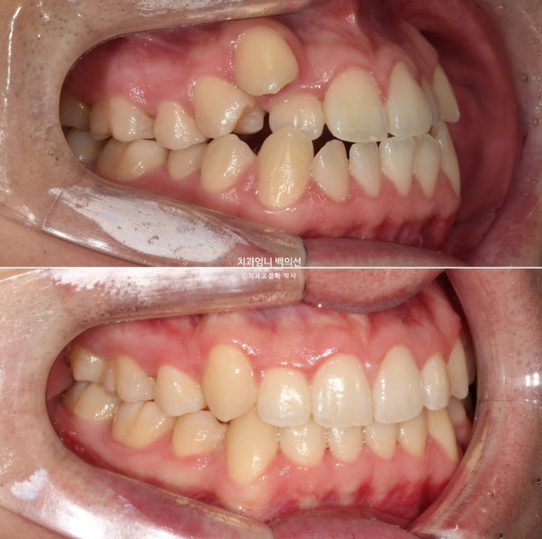 투명교정 인비절라인 덧니 교정 치료기간 알아보기 관련 이미지 12