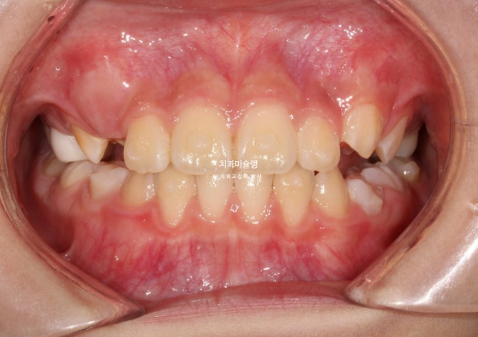 어린이 돌출입 교정 무턱 투명교정 인비절라인 퍼스트 관련 이미지 8