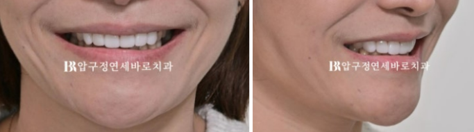 벌어진 치아 교정 인비절라인 라이트 무삭제 라미네이트 치료 관련 이미지 19