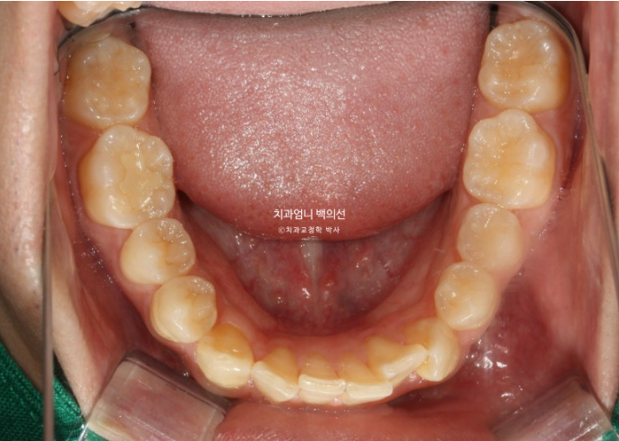 인비절라인 비발치 앞니 돌출 덧니 교정 ? 관련 이미지 5