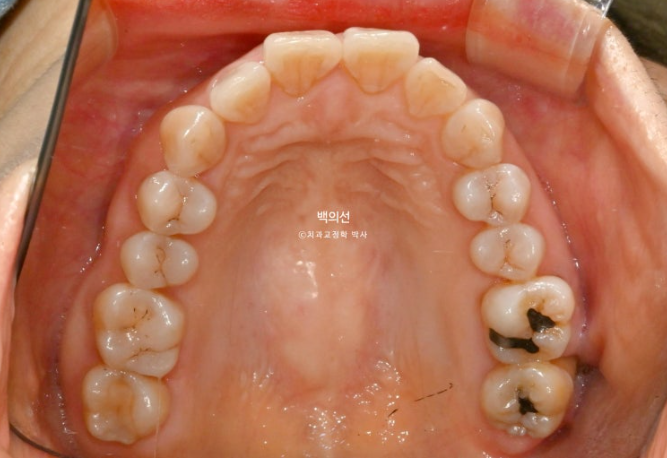 40대 인비절라인 라이트 앞니 돌출 과개교합 덧니 교정 후기 관련 이미지 5