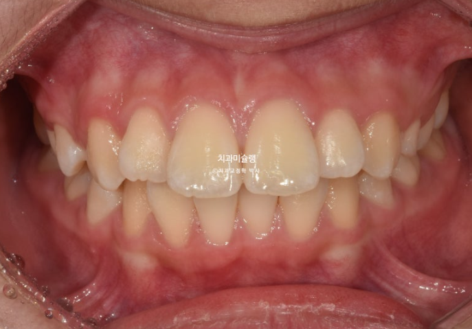 돌출입 비발치 어린이 교정 입술부전증 호두주름 호두턱 토끼이빨 인비절라인퍼스트 관련 이미지 2