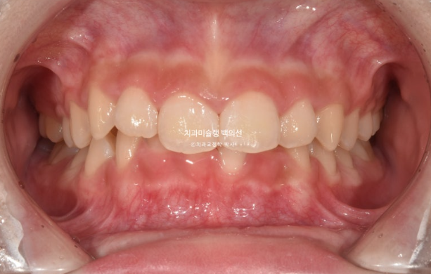 과개교합 인비절라인 모더레이트 컴프레헨시브 중심선 토끼이빨 관련 이미지 2