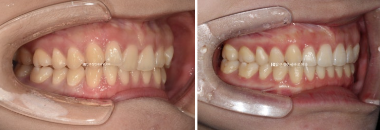 옥니 교정 인비절라인 라이트 옹니 덧니 치료기간 ? 관련 이미지 10