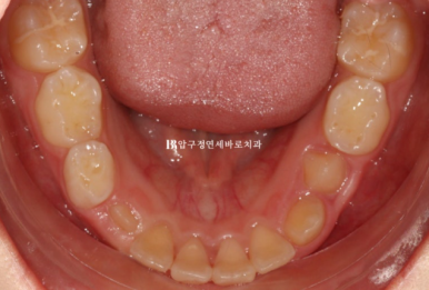 소아 투명교정 인비절라인 퍼스트 후기 기록 관련 이미지 15