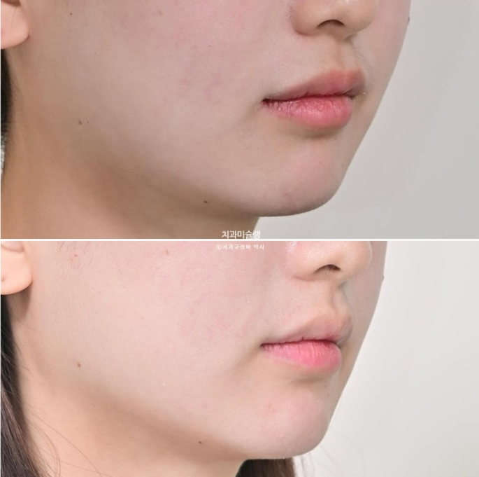 덧니 인비절라인 라이트 잇몸미소 거미스마일 중심선 블랙트라이앵글 관련 이미지 22