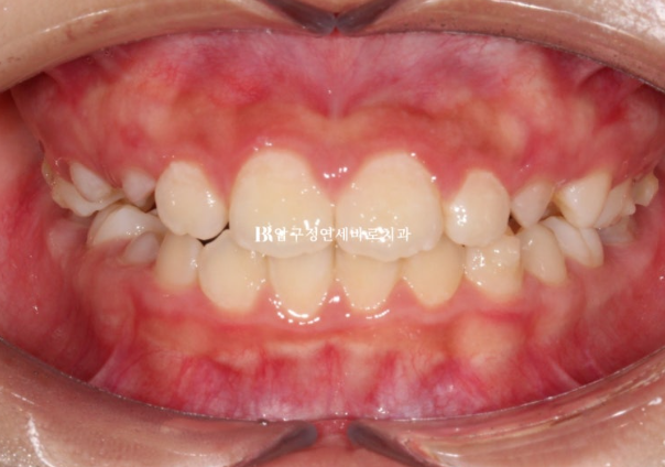 A Child’s Protruding Teeth Correction Review: Difficulty Closing the Lips image 6