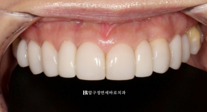 오래된 앞니 크라운 교체와 블랙트라이앵글 개선, 무삭제 라미네이트 사례 관련 이미지 4