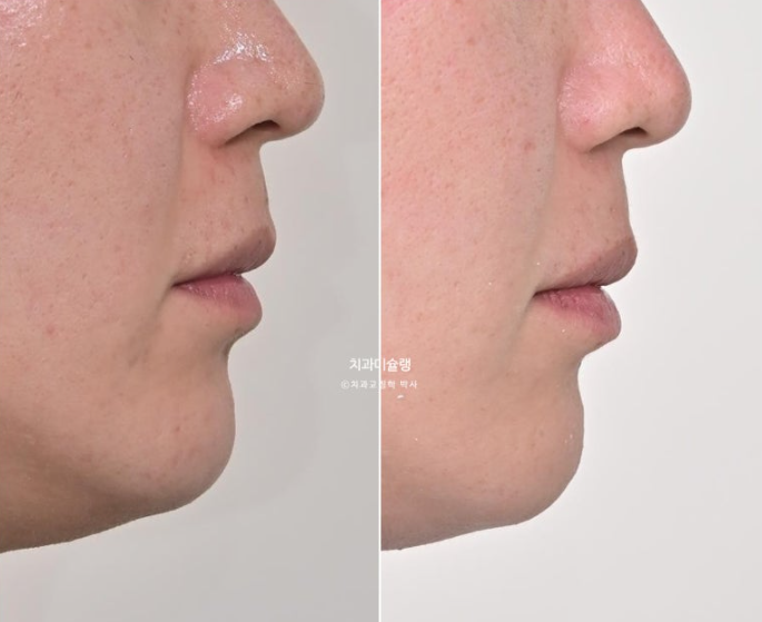 덧니 앞니 부분교정 급속교정 단기 MTA 미니튜브 기간 6개월 관련 이미지 16