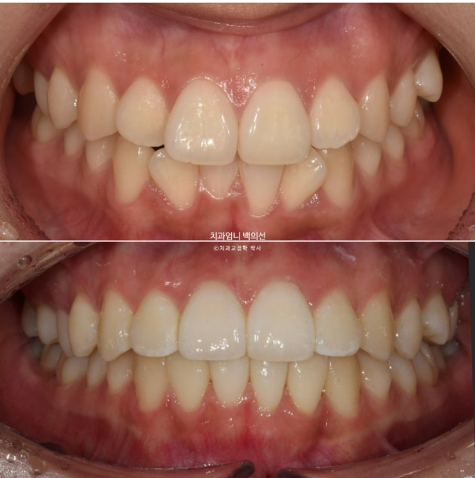 앞니 부분 교정 토끼이빨 덧니교정 ? 관련 이미지 1