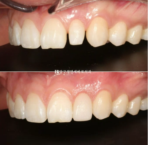 급속 교정 앞니부분교정 치료 무삭제 라미네이트 후기 관련 이미지 7