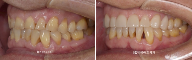 60대 무삭제 라미네이트 앞니 부분교정 치료 관련 이미지 10