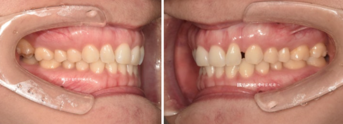 인비절라인 라이트 가위교합 벌어짐 중심선 미니스크류 치료기간 11개월 관련 이미지 3