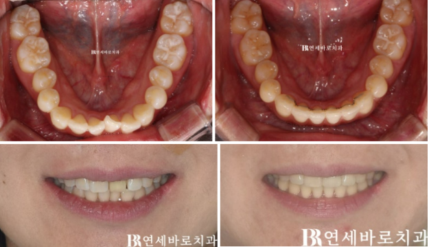 임플란트 없이 자연치아 살리기 앞니 부분교정 보철교정 관련 이미지 7