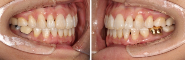 Can Invisalign Lite Work for People in Their 50s? A Real Middle-Aged Orthodontic Case Improving Butterfly Teeth and Gum Recession image 10