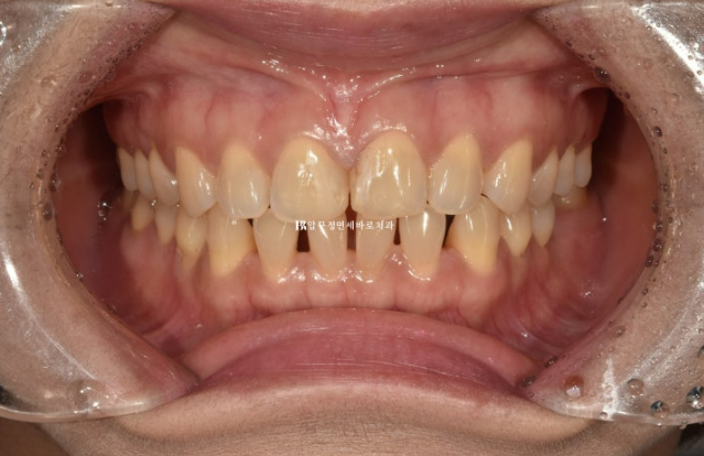벌어진 치아 교정 인비절라인 라이트 무삭제 라미네이트 치료 관련 이미지 2