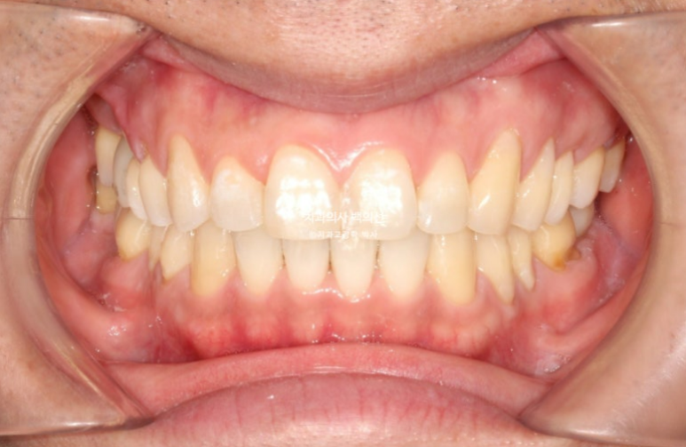 40대 인비절라인 라이트 과개교합 과잉치 덧니 교정 임플란트 보철 교정 후기 관련 이미지 16