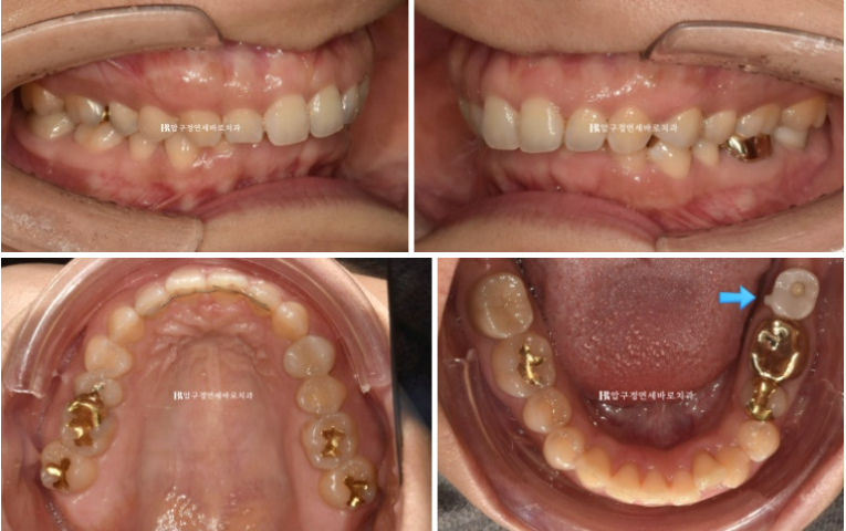 인비절라인 캔팅 교정 과개교합 교정 임플란트 재교정 관련 이미지 3