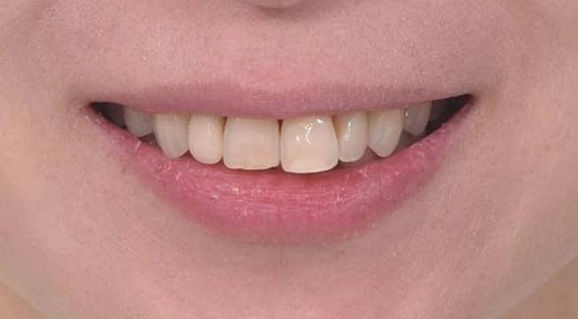 Invisalign Lite for Orthodontic Treatment in Your 40s: Crossbite and Protrusive Mouth Correction image 2