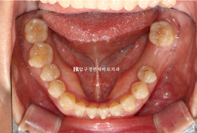 벌어진 치아 교정 인비절라인 라이트 무삭제 라미네이트 치료 관련 이미지 14
