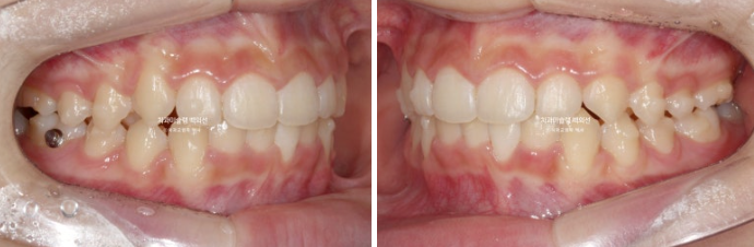 과개교합 인비절라인 모더레이트 컴프레헨시브 중심선 토끼이빨 관련 이미지 8