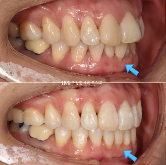 50대 중년교정 인비절라인 라이트 나비치아 교정 앞니 교정 후기 관련 이미지 1