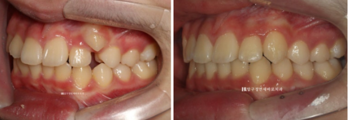 덧니 인비절라인 교정 :: 강남 인비절라인 교정치과 관련 이미지 7