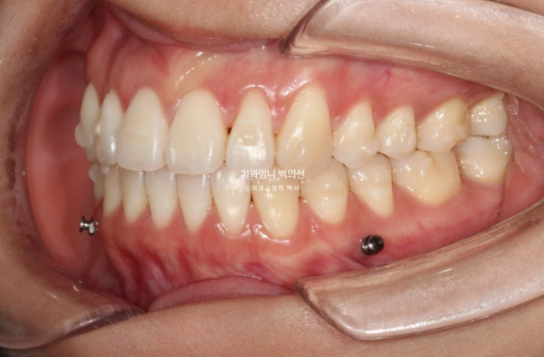 인비절라인 개방교합 교정 어금니 함입 교정 비베라? 관련 이미지 6