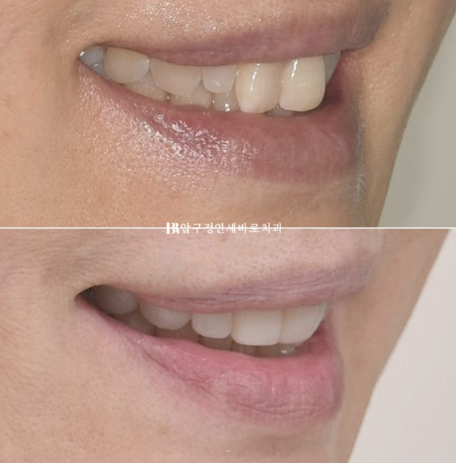Can It Be Done in Your 50s? Real Results from Limited Front Teeth Orthodontics + No-Prep Laminate Veneers Revealed image 17