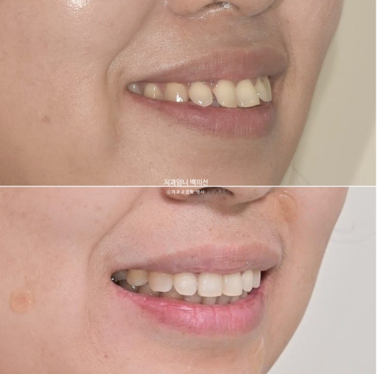 40대 인비절라인 라이트 앞니 벌어짐 뻗침 돌출 치료 관련 이미지 21