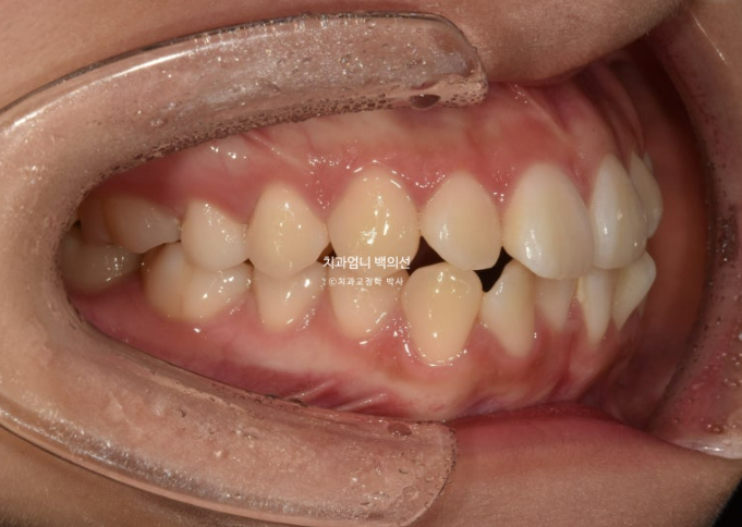 앞니 부분 교정 토끼이빨 덧니교정 ? 관련 이미지 3